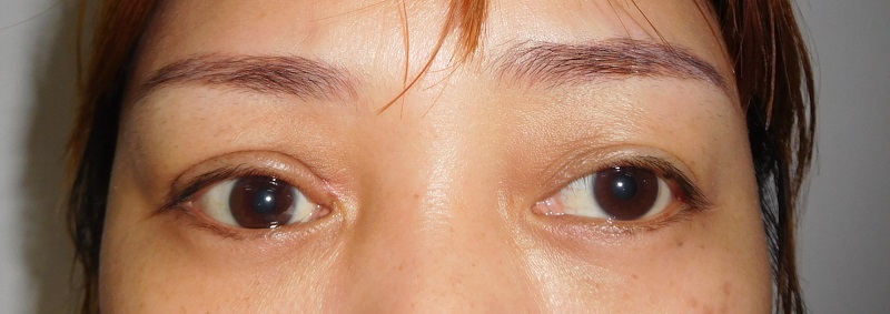 甲狀腺相關性眼病