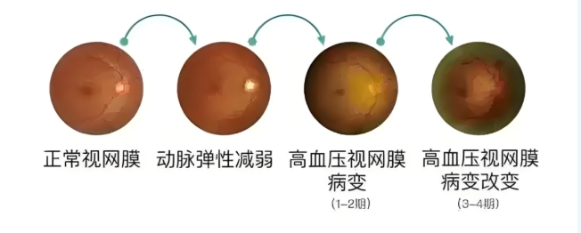 視網(wǎng)膜中央動(dòng)脈阻塞